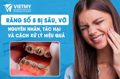 Răng Số 8 Bị Sâu Vỡ: Nguyên Nhân, Tác Hại và Cách Xử Lý Hiệu Quả